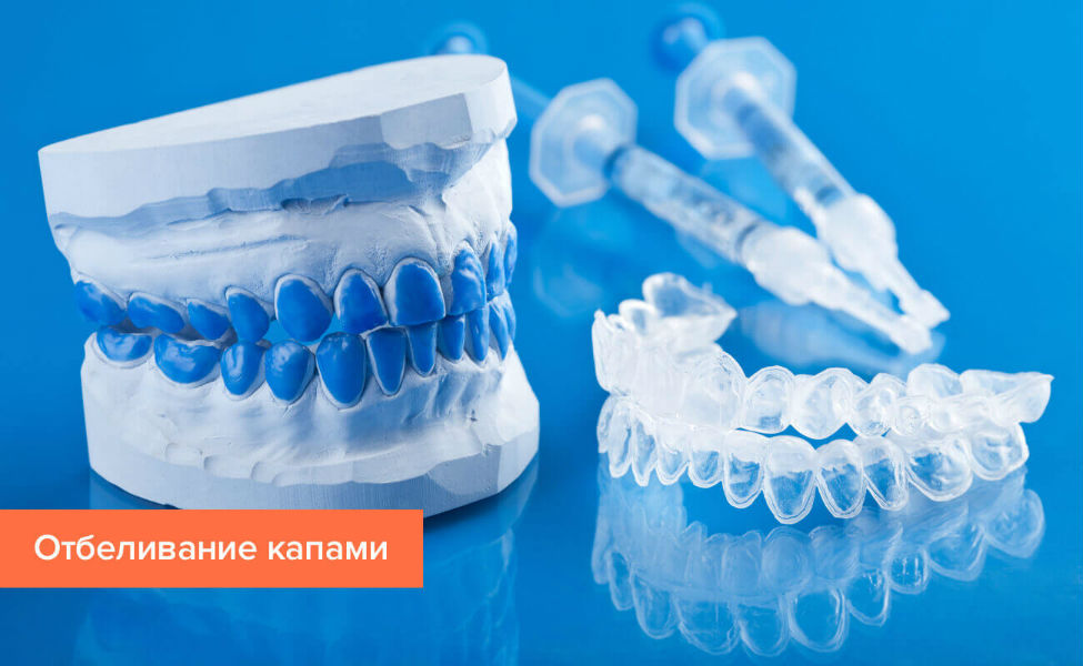 Домашние отбеливние зубов в Киеве - назначение зубной капы для отбелки стоматологом клиники Фортуна